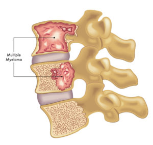 Myeloma | Apconix