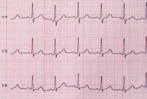 ECG