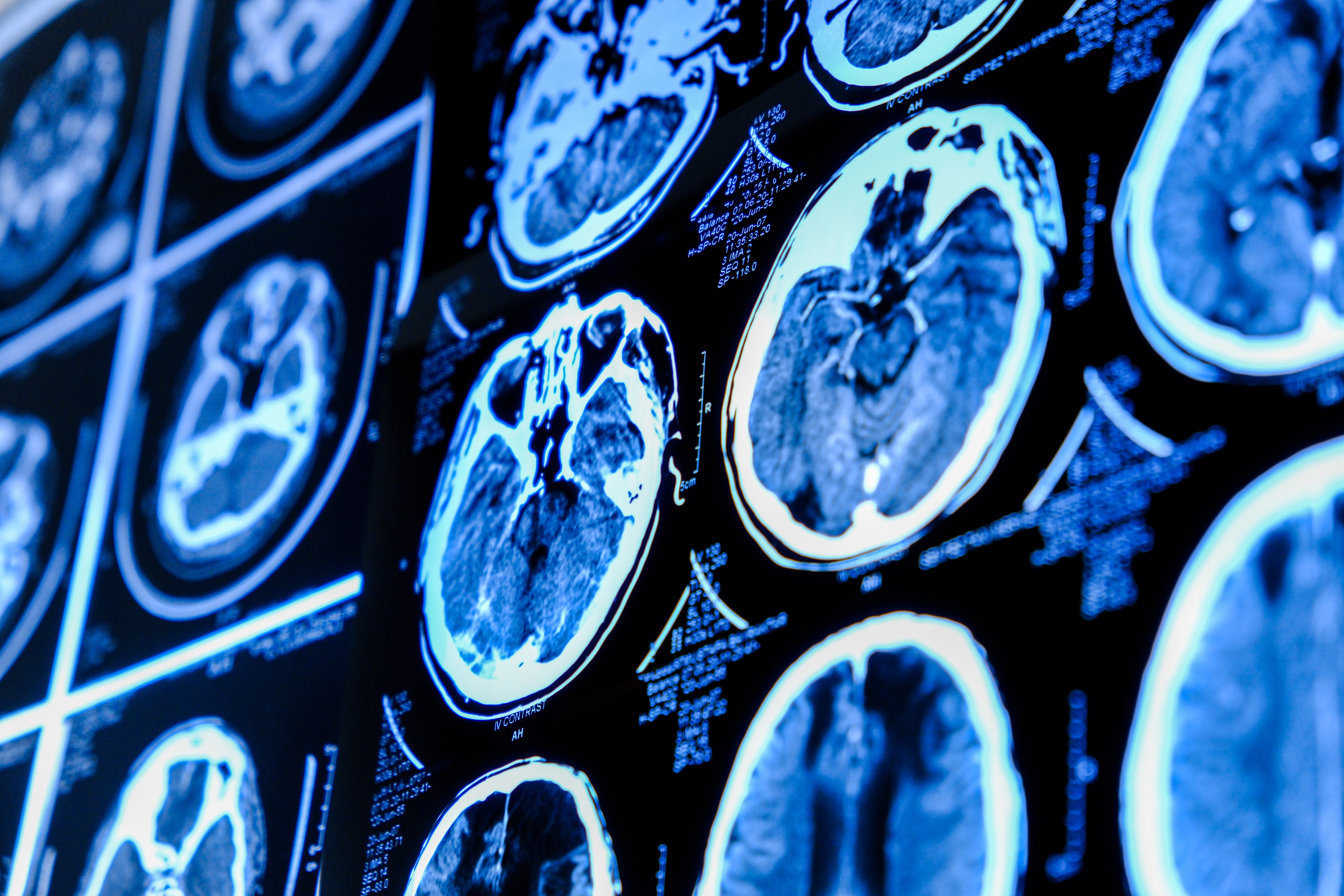 Close-Up,Of,Ct,Scan,With,Brain.,Medicine,,Science,And,Education Shutterstock 2284247721 | Apconix